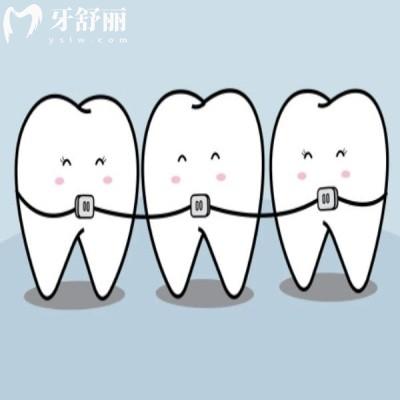 上海牙齒矯正多少錢2025價(jià)格表:上海成人/兒童牙齒正畸多少錢都有