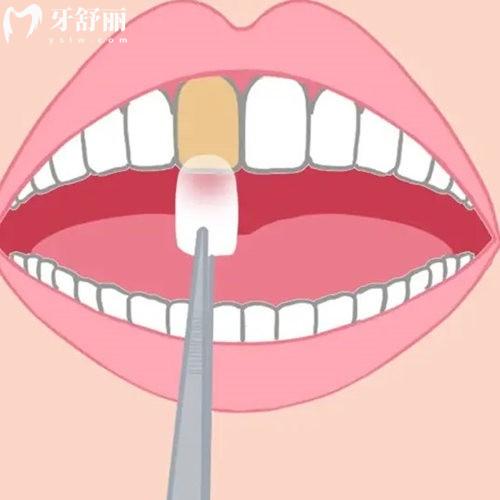 分析氟斑牙治療的3種方法:牙齒美白/瓷貼面/冠修復(fù)的不同之處及價格