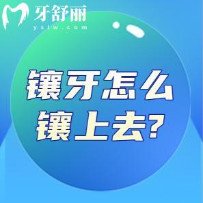 鑲牙怎么鑲上去?分享鑲牙過(guò)程圖解圖片大全(含活動(dòng)牙/固定義齒/種植牙)
