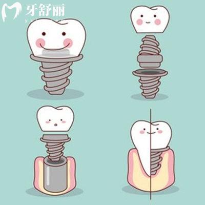 登特斯dentis種植牙是哪國的？質(zhì)量怎么樣？從優(yōu)缺點、價格、使用壽命多個方面介紹