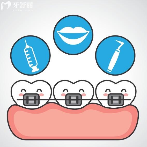 正畸小白必知:自鎖VS非自鎖托槽哪個(gè)好?對(duì)比材質(zhì)/療效/價(jià)格等區(qū)別