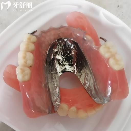 純鈦支架活動義齒優(yōu)缺點+價格大全!總結(jié)優(yōu)缺點與費用,選對不花冤枉錢！