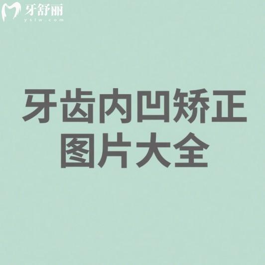一鍵查看牙齒內(nèi)凹矯正圖片大全,還有治療方案及價(jià)格表,把握兒童矯正黃金期