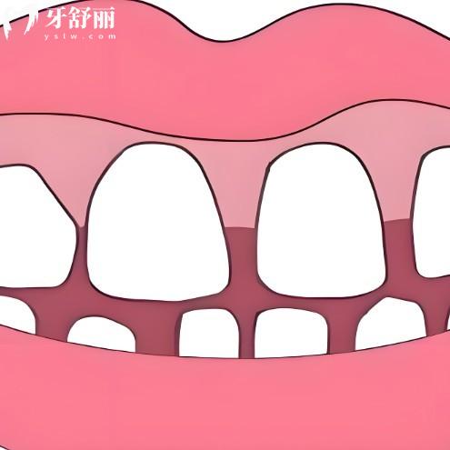 門牙牙縫大修復(fù)比較好的方法及價格表:對比不同修復(fù)方式的持久性及美觀度