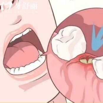 拔牙后的干槽癥有哪些表現(xiàn)？簡單四大癥狀可以自查