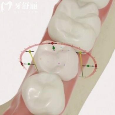 Dio種植體不是雜牌！韓系“性價比王”的真相大揭秘
