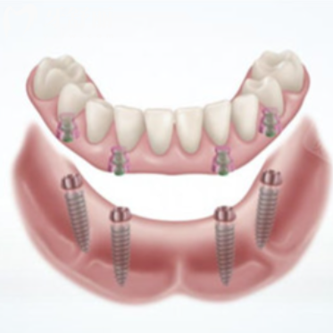馬龍橋VS普通支架的區(qū)別：口腔修復(fù)選誰(shuí)不踩坑？一文說(shuō)清區(qū)別