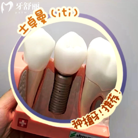 瑞士ITI種植牙能用多久？揭秘影響壽命的五大關(guān)鍵因素