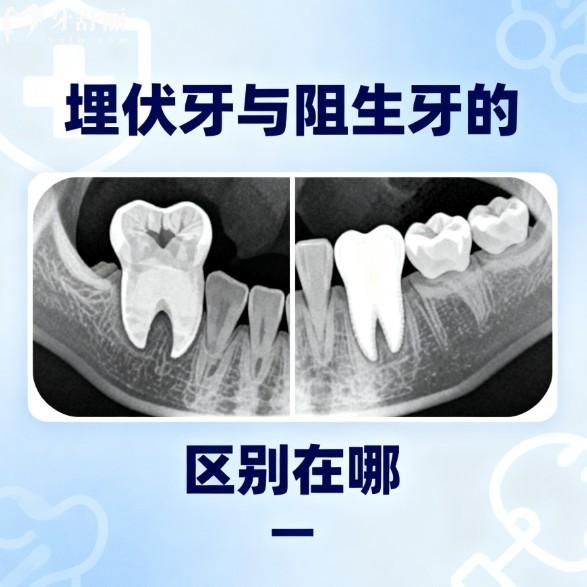 埋伏牙與阻生牙的區(qū)別在哪?還有相對(duì)應(yīng)的治療方案及術(shù)后注意事項(xiàng)分享