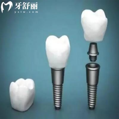 想知道洛陽種植牙多少錢?剛整理的洛陽種植體品牌價格表供參考