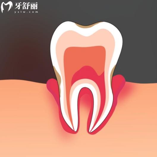 牙槽骨吸收了還能長(zhǎng)回來(lái)嗎？其實(shí)不一定進(jìn)來(lái)看看自己是哪種類型